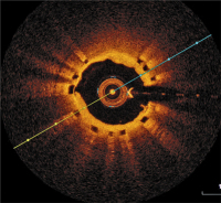Abbildung 6: ISR post-POBA