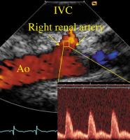 Figure 1: Intrakardiale Echokardiographie