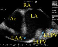 Figure 3: Intrakardialer Ultraschall