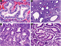 Abbildung 1a-d: Endometriumveränderungen