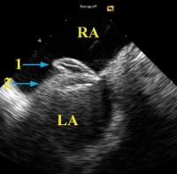 Figure 5: Intrakardiale Echokardiographie