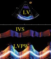 Figure 6: Intrakardiale Echokardiographie