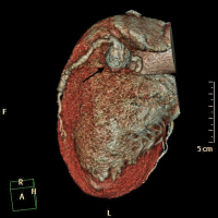 Abbildung 1: Aneurysma