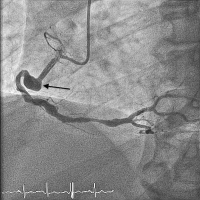Abbildung 3: Aneurysma