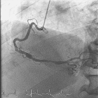 Abbildung 4: Aneurysma