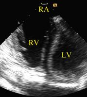 Figure 8: Intrakardiale Echokardiographie