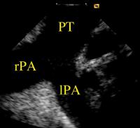 Figure 9: Intrakardiale Echokardiographie