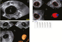 Abbildung 7a-d: Adnexzyste