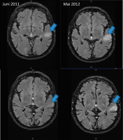 Abbildung 1: Glioblastom