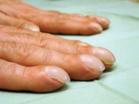 Abbildung 1: Respiratorische Bronchiolitis