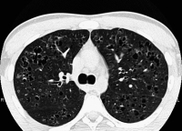 Abbildung 3: Pulmonale Langerhanszell-Histiozytose