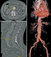 Abbildung 1: Aortenaneurysma