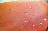 Abbildung 1: Aneurysma spurium