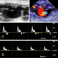 Abbildung 2a-d: Bypass-Ruptur