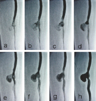 Abbildung 4a-h: Pathologische Bypass-Hämodynamik
