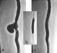 Abbildung 5a-c: Aneurysma spurium
