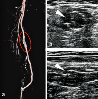 Abbildung 6a-c: Stentfraktur Typ III