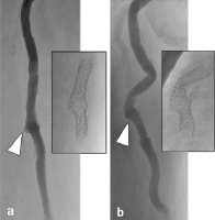 Abbildung 7a-b: Bypass