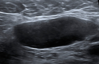 Abbildung 2: Ultraschall-Lymphknoten