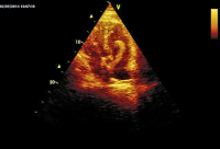 Abbildung 2: Apikaler Vierkammerblick
