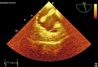 Abbildung 4: Thromboembolus