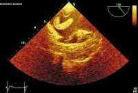 Abbildung 5: Thromboembolus