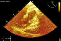 Abbildung 7: Thromboembolus
