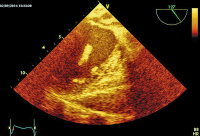 Abbildung 8: Thromboembolus