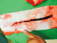 Abbildung 9: Thrombus