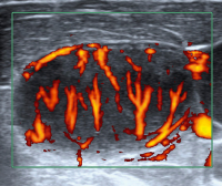 Abbildung 2: Lymphknoten-Ultraschall