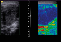 Abbildung 7: Lymphknoten-Elastographie