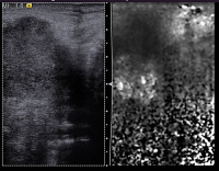 Abbildung 8: Lymphknoten-Elastographie