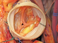 Abbildung 1: Aortenklappe