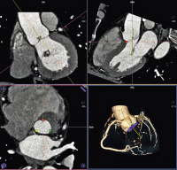 Abbildung 1: Produkt: TAVI<br>Vertrieb: Siemens AG