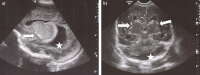Abbildung 5a-b: Schädelsonographie