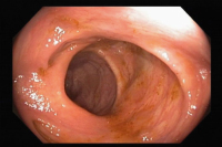 Abbildung 1: Koloskopie