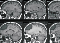 Abbildung 2: Endodermale Zyste