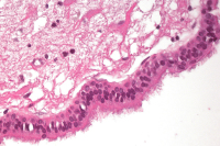 Abbildung 3: Endodermale Zyste