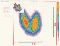 Abbildung 1: Hyperthyreose