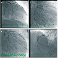 Abbildung 5a-d: Koronarangiographie