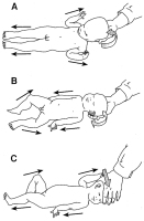 Abbildung 2A-C: Nackenreflex-Säugling