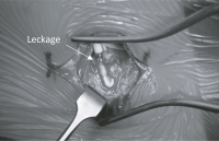 Abbildung 2: Spinaler Katheter