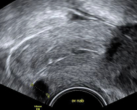 Abbildung 2: Ovulum Nabothii