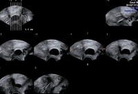 Abbildung 4: Ovulum Nabothii