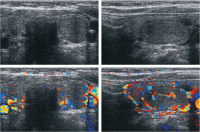 Abbildung 1: Knoten - Schilddrüse