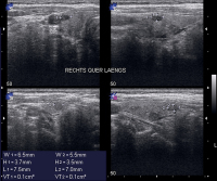 Abbildung 2: Läsion - Schilddrüse