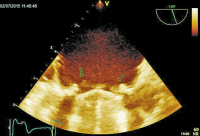 Abbildung 1: Mitralklappenprothese