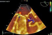 Abbildung 2: Mitralklappenprothese - Regurgitation