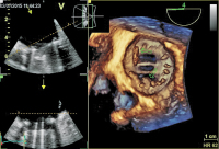 Abbildung 3: Mitralklappenprothese - Chirurgenblick