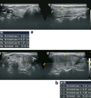 Abbildung 1a-b: Subakute Thyreoiditis